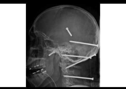 2004'te yaanan bir kaza sonucu inaat iisi Isidro Mejia'nn kafasna ivi makinesinden frlayan alt ivi saplanmt. i, geirdii ameliyatlar sonucu kurtarld.