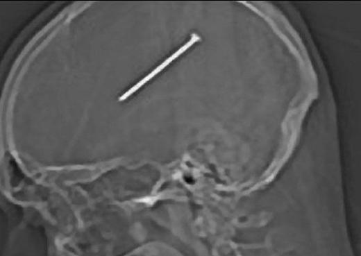 Chicago'da yaayan 32 yandaki Dante Aytullo, kaza sonucu iviyi kendi kafasna 'akt'. stelik bunu tam 24 saat sonra fark etti.