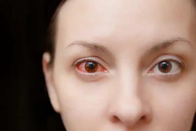 Havlu, yast�k ve makyaj malzemesinin ki�isel oldu�unu ve g�z k�zar�kl���n�n hafife al�nmamas� vurgusu yap�ld�.<o:p></o:p>