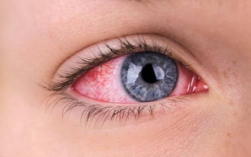 Toplumda k�rm�z� g�z hastal��� olarak bilinen <strong>“adenoviral konjonktivit”</strong> yeniden g�ndeme geldi.