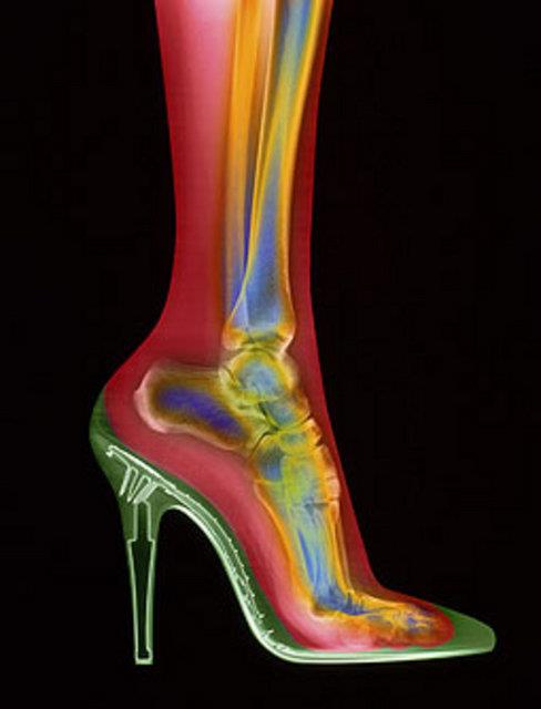 Bu rntgen filmindeki geree gre topuklu ayakkabnn ayamz iin ok salkl olmad...