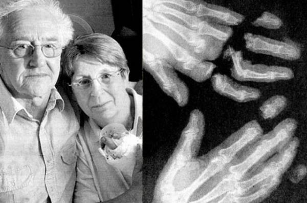 Bu rntgen filmi ise ngiltere'de bir biskvi fabrikasnda alan Anne Kellow'a ait. Kellow'un i yerinde geirdii talihsiz kaza parmaklarnn krlmasyla sonuland.