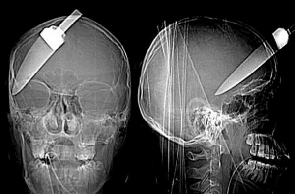 Londra'da bana bak saplanan 16 yandaki bu ocuk bir mucize eseri kurtuldu.