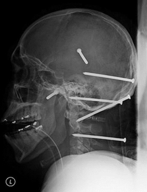 sidro Mejia adl Los Angeles'ta yaayan bir inaat iisi geirdii kazayla lmden dnd. Bir anlk dikkatsizlik sonucu makinadan frlayan tam alt ivi kafatas ve boynuna sapland.