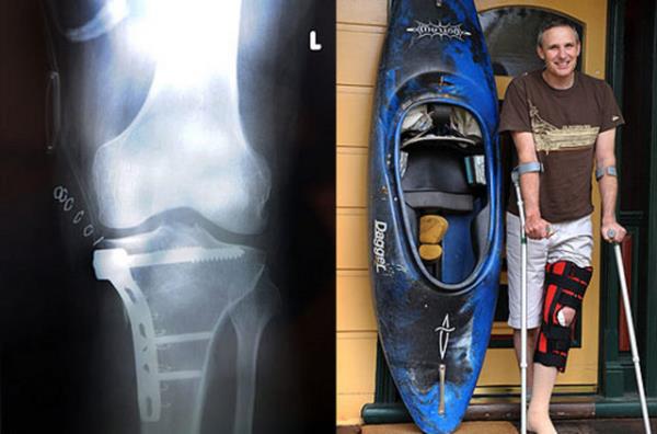 Su sporlaryla uraan David Wilson geirdii kazann ardndan salna kavuabilmek iin uzun bir sre dizindeki vidalarla yaamak zorunda.