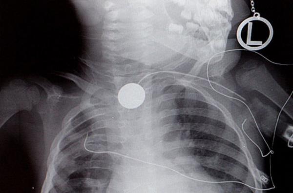 Yemek borusuna metal para skm bir ocuun rntgeni...