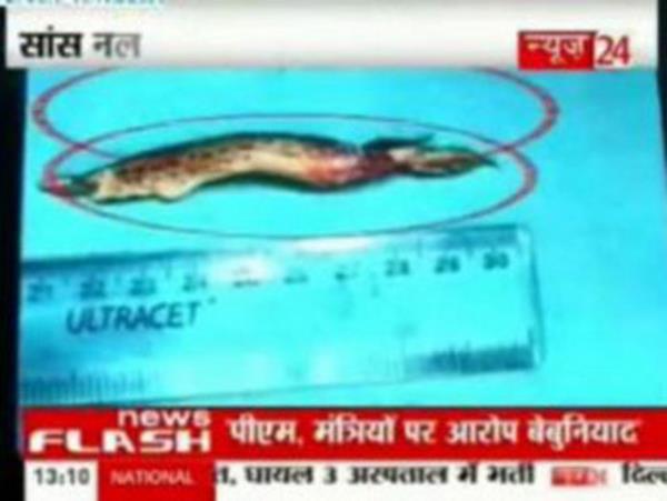 ekimlerde cierlerinde dolaan balk tespit edilince ocuk hemen ameliyata alnd. Yaklak 45 dakikalk operasyonun ardndan balk, canl olarak karld. Gs hastalklar uzman Doktor Pramod Jhawar, 20 yllk doktorluk hayat sresince ilk kez byle bir durumla karlatn kaydetti.