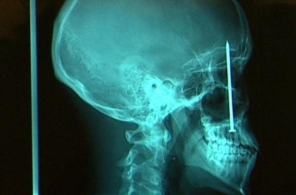 Azna ivi saplanan hastann ameliyata alnmadan nce ekilen rntgen filmi...