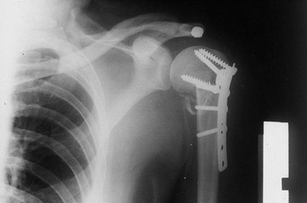 Omzu krlan bir kiinin koluna yaplan mdahalenin grnts...