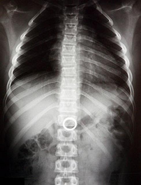 Annesinin evlilik yzn yutan ufak kz ocuunun rntgen filmi.