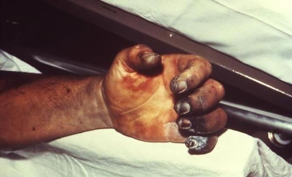 Belgelerde salgn sebebi hyarck vebas ve trleri gibi gzkse de bu konuda bir kant bulunmamaktadr. Gnmz modern aratrmaclar ise belirtilerin kanamal atee benzediini belirtiyor.