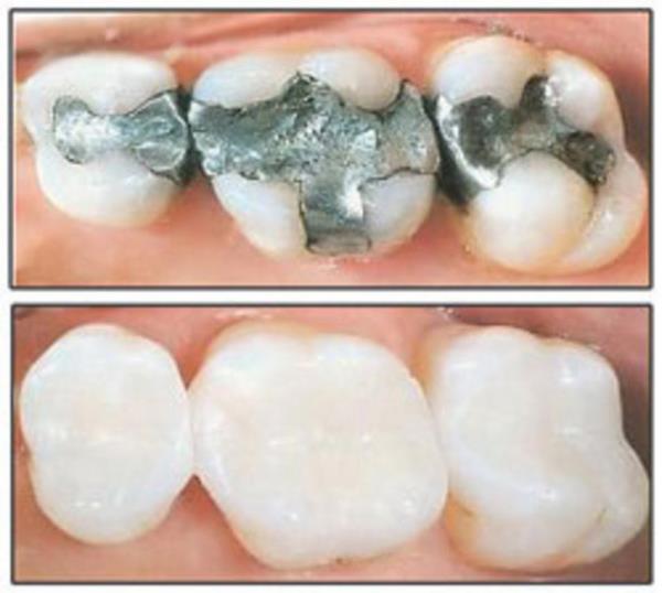 Civann kana karabileceini uyarsnda bulunan beslenme uzman Prof. Dr. Ahmet Aydn, amalgam dolguda bulanan civalarn zaman iinde kronik zehirlenmelere neden olabileceini belirtti. Kompozit dolgularn kullanlmas gerektiini kaydetti.