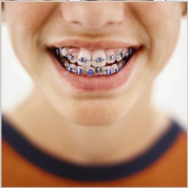 Di eti hastalklarnn ilerlemi aamas olan peridontitis di eti enfeksiyonudur.