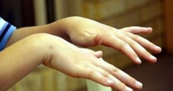 Stres, youn ay ve kahve imek, alk, yorgunluk, ani sinirlenme gibi baz durumlar titremeyi fark edilir hale getirebilir. Bu faktr ortadan kalknca kii eski haline dnebilmektedir.