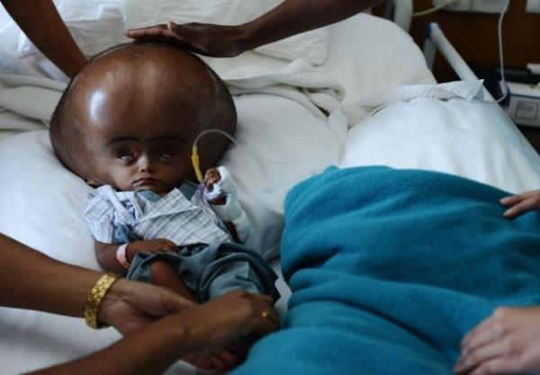 <p><b>Nisan</b></p>  Hindistan'�n Gurgaon kentinde ya�ayan 15 Ayl�k Roona Begum, kafas�n�n s�rekli b�y�mesine neden olan hastal�ktan kurtulmak i�in ameliyat edildi.