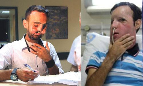 (18 TEMMUZ) TRKYE'NN 5. YZ NAKL YAPILDI- Mula?da beyin lm gerekleen Polonyal turist Andrzej Kucza?nn yz ve enesi, Akdeniz niversitesi Tp Fakltesi Plastik, Rekonstrktif ve Estetik Cerrahi Anabilim Dal retim yesi Prof. Dr. mer zkan bakanlndaki ekip tarafndan, 1 yldr nakil bekleyen 26 yandaki Recep Sert?e nakledildi.