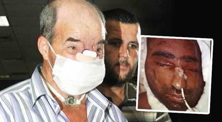 (22 AUSTOS) 6. YZ NAKL YAPILDI- Trkiye?nin 6. yz nakli yapld. Antalya?da beyin lm gerekleen Muhittin Turan?n yz 8 saat sren operasyonla alnarak Prof. Dr. mer zkan bakanlndaki ekip tarafndan gerekletirilen ameliyatla 54 yandaki Salih sln?e nakledildi.