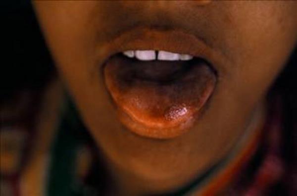 Arsenik, tm insanlarn dokularnda iz olarak bulunmaktadr. Zehir olarak kullanldndaysa mide rahatszlanr, kusma ba gsterir ve hasta kanl ishal olur.