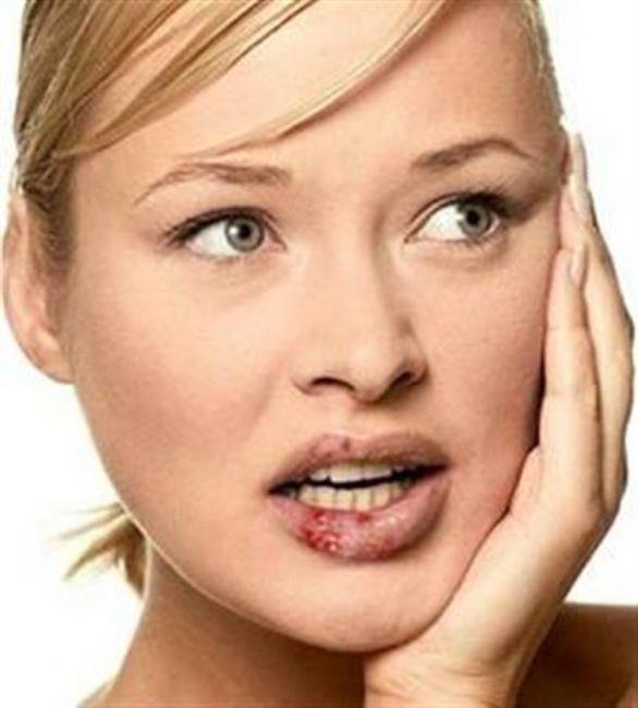 Uuklar geiriyor:   Macar uzmanlar tarafndan yaplan bir aratrmaya gre, her gn alnacak 125 miligram Aspirin uuklarn cilt zerindeki mrn ortalama 8 gnden 5 gne drerek, neredeyse yar yarya azaltabiliyor. Aspirin, uua neden olan iltihab da azaltarak, etkilenmi blgenin daha abuk iyilemesini salyor.