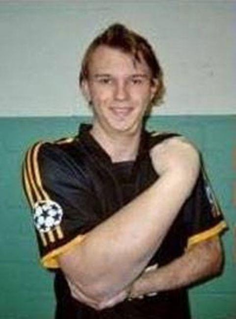 Bu genetik bozukluk ona yaratc bir fikir verdi. Artk o bir bilek greisi.