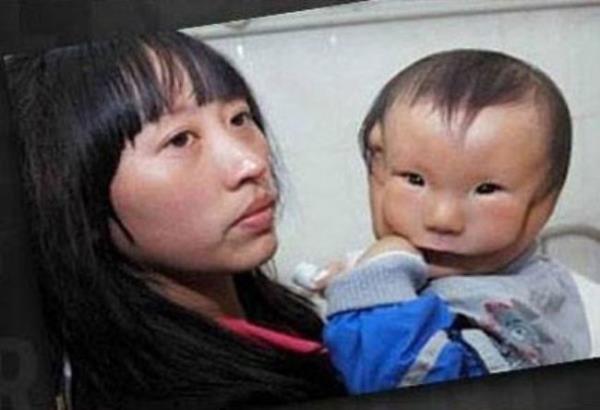 Kangkang 14 aylk bir bebek. inli bebek deformasyon yznden adeta maske takm gibi bir yze sahip. Yznn azna kadar olan ksm geri kalanndan daha nde duruyor.