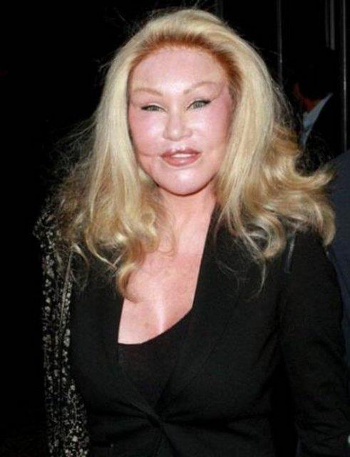 Jocelyn Wildenstein ya da daha ok bilinen adyla Kedi Kadn sadece botoks deil her tr estetik operasyon yaptryor.