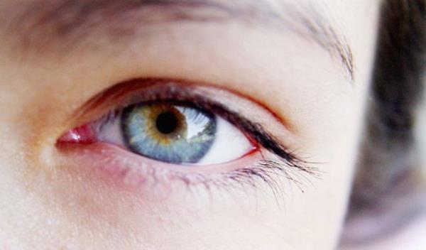 6- zellikle renkli gzl kiiler gne na daha hassas olurlar. Renkli gzl kiilerde kzarklk grlme oran koyu renkli gzllere gre daha fazladr. Bu nedenle renkli gzl kiilerde gne gzl kullanm daha nemlidir.