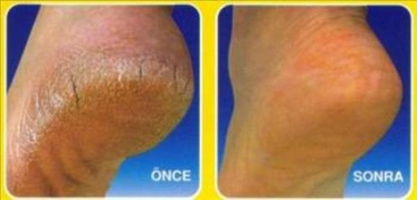 <p>Topuklarnz sertleiyorsa? </p>  Ayaklarnza bir su iesi ile iki- dakika boyunca masaj yapn. Bu ilem sayesinde ayak tabannzdaki ukur blge gerilir ve topuunuzun dzlemesini engellemi olursunuz.