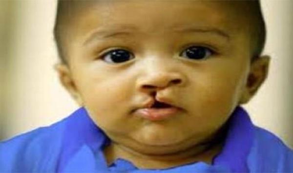 Doan bebeklerin 15'i "engelli" olacak.