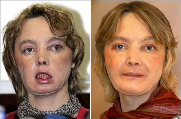 Isabelle Dinoire'ye dnyann ilk ksmi yz nakli yapld. (2005)