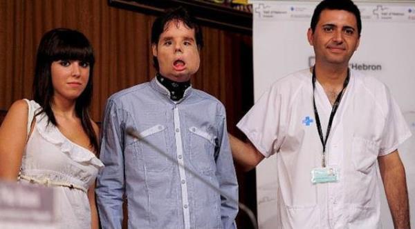 Sadece 5 yl sonra, Oscar isimli spanyol iftiye ilk tam yz nakli yapld. (2010)