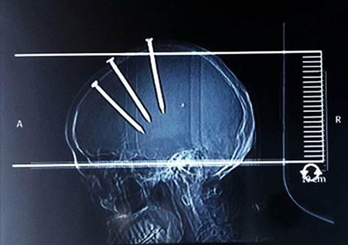 ivilerin balar aka dardan bile grnrken doktorlar inli adamn rntgenini ekti ve 3 koca ivi ile karlat...