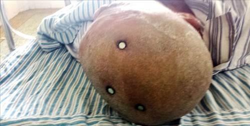 Hemen ameliyata alnan adamn bandaki iviler teker teker karld...