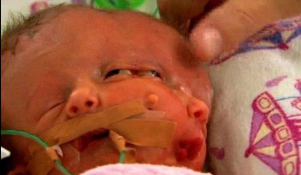 ki yzl doan bebek yaam mcadelesi veriyor