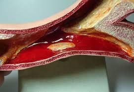 Ayrca, iyi (HDL) kolesterol dk olan kiilerde de inmelerin artt gzlendi. Bu tarz olumsuzluklarn toplumsal riske katksnn yzde 25 olduu saptand.