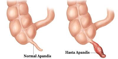 <p><b>Belirtileri</b></p>  Gbek etrafnda balayp, sa tarafa doru inen bir ar ile bulant, kusma ve itahszlk grlrse apandisit ihtimalinin deerlendirilmesi gerekir.