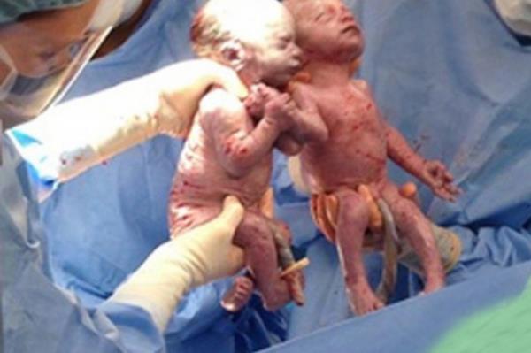 ABD`de Anneler Gn`nde doan ikizlerin durumu doktorlar dahil herkesi duygulandrd. Ana rahminde nadir grlen bir durum nedeniyle yakn temas iinde bulunan ve sezaryenle doan ikizler el ele dnyaya geldi. Monoamniyotik denilen ikizlere Jillian ve Jenna ismi verildi. zel bir gnde ocuklarn kucana alan anne Sarah Thistletwaite, "Kzlarmn iyi olduunu bilmek o kadar harika bir duygu ki kelimeler yetersiz kalyor. Onlar kucama almak ve iyi olduklarn bilmek harika bir ey." dedi.