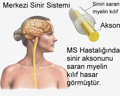 <p>Multipl Skleroz ya da k�saca "MS", beyin ve omurili�in olu�turdu�u merkezi sinir sisteminin gen� eri�kin ya� grubunda en yayg�n n�rolojik hastal�klar�ndan birisidir.</p>  Bayanlarda MS neredeyse %80 orandad�r. Erkeklerde ise %20 oran�ndad�r.   <p> Aya��n� s�rmeye ba�lamak, kollarda uyu�ma, g�zlerde �ift g�rme, ge�ici g�rmeme �ikayetleriyle ba�lang�� g�sterir. Hastan�n akut durumunu a�abilmesi i�in, kal�c� hasar g�r�lmemesi i�in y�ksek dozda kortizon veriliyor. .