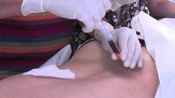 Kemik ilii hcre nakli (Akraba d): 210 bin TL