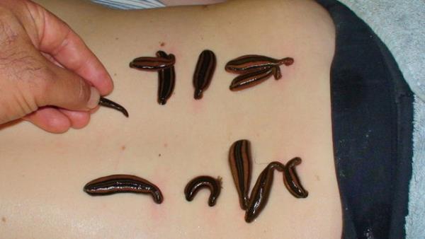 Hirudoterapi 50-75 TL