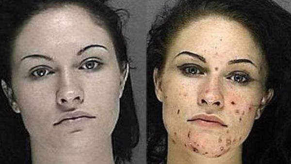 Uyuturucu kullanm sadece bamllk yaratp lme yol amyor, ayn zamanda insan vcudunun da gnden gne rmesine neden oluyor. te uyuturucu kullanm ncesi ve sonras bamllarn profil fotoraflar...