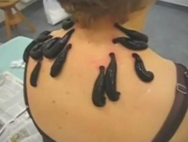 Tbbi slkler: Slkler, eski alarda da gnmzde de doktorlarnn birok hastala neden olduunu dndkleri kirli kan ekmek iin kullanlyor.