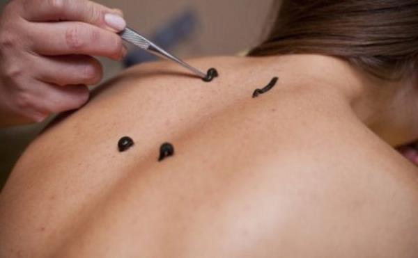 Modern tpta, slklere rekonstraktif cerrahide kan akn hzlandrmak iin bavuruluyor .