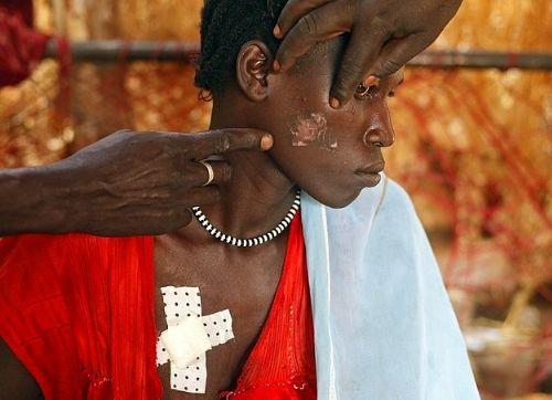 <p><b>SUDAN </b></p>    Sudan'da kzlar iin yasal evlenme ya 10'dur. Ortalama olarak her 30 kadndan 1'i hamilelik srasnda hayatn kaybetmektedir. Sudan'da ise kadnlarn binde 7.3' doum srasnda hayatn kaybetmektedir. Bu fotoraf; Sudan'da derme atma hastanede tedavi grmeye alan Sudanl bir kadna ait.