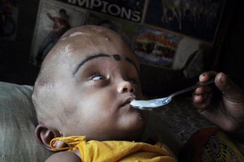  yanda 'yaama ans ok dk' denilen Roona Begum geirdii ameliyat sonrasnda ilk defa glmsedi.