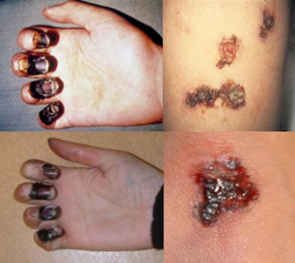 13. yzylda Orta Asya'da patlak veren Veba,ok hzl bir ekilde yaylarak Avrupa'y da etkisi altna ald. 75 milyon kiinin lmne yol aan bu hastalk ar, ate ve bulantyla balyordu.