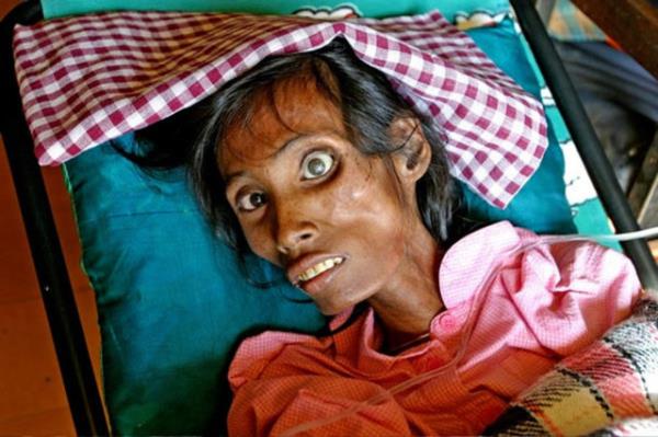 AIDS 1981'den bu yana 25 milyon can ald.