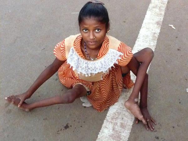 OCUK FELC Bir virs tarafndan oluturulan bulac bir enfeksiyon hastaldr. Sinir sistemini istila ederek kalc fellere veya lme neden olabilir.