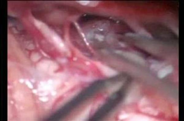 Beyninden solucan kt Amerika Arizona eyaletinde beyninde tmr olduu dnlen bir kadn ameliyat edilince, tmr sandklar eyin canl bir solucan olduu anlald. Operasyonun okunu atlatan doktorlar bu durumu yle akladlar: