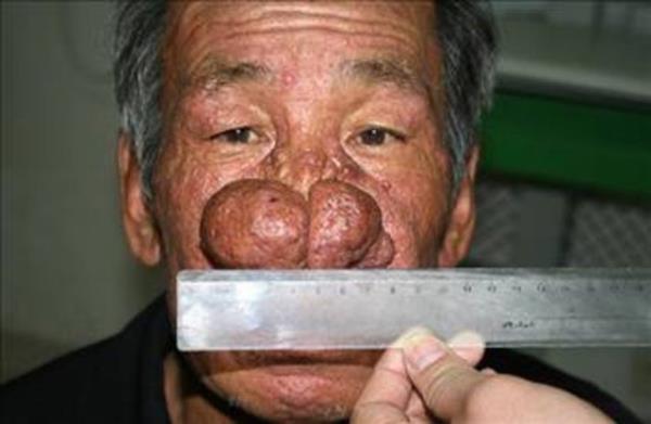 52 yl boyunca her gn 2 litre brandy ien 68 yandaki Liu Ge, "rhinophyma" denilen burundaki kan damarlarnn srekli olarak imesine yol aan bir hastala yakaland.